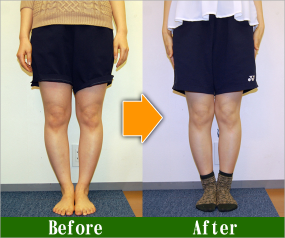 Ｏ脚矯正改善写真102