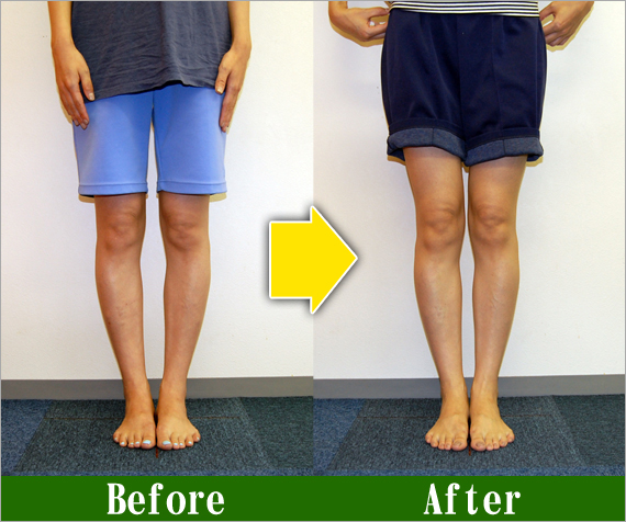Ｏ脚矯正改善写真11