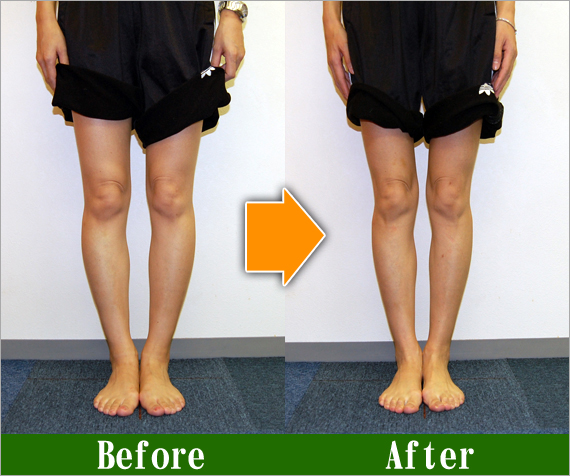 Ｏ脚矯正改善写真12