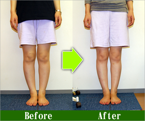 Ｏ脚矯正改善写真28