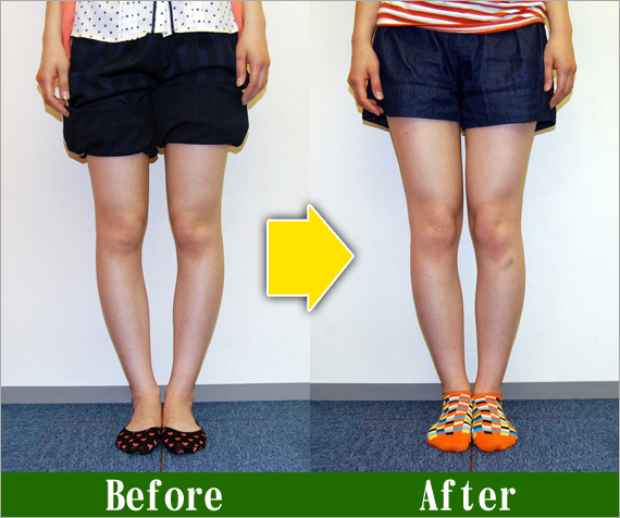 Ｏ脚矯正改善写真29