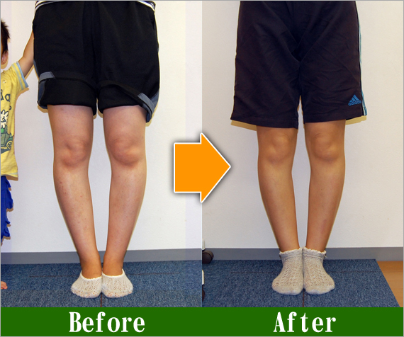 O脚改善写真その5 | O脚矯正の改善事例100名以上・京都二条のトオル