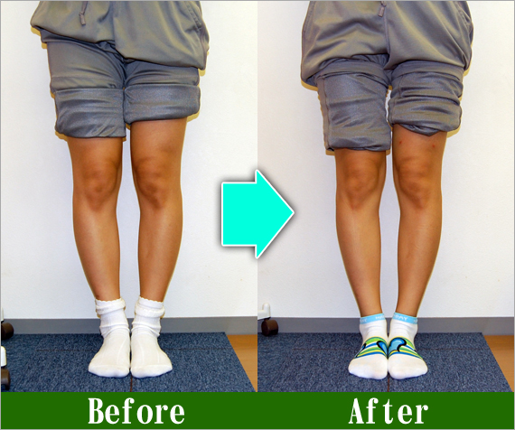 O脚矯正改善写真33