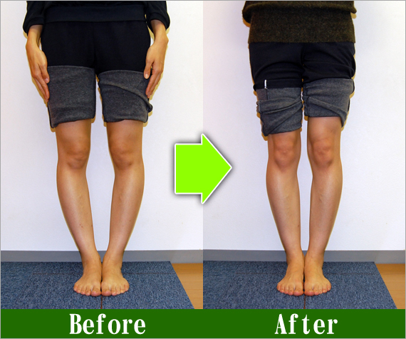 O脚矯正改善写真34