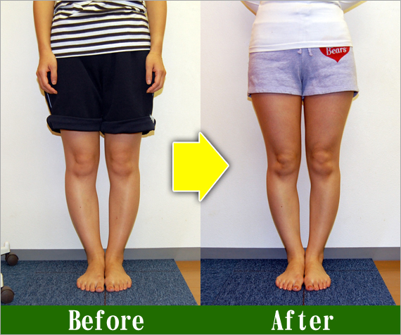 O脚矯正改善写真35