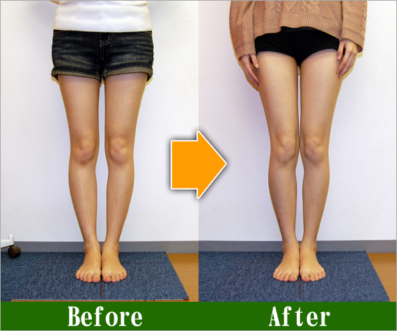 O脚矯正改善写真36