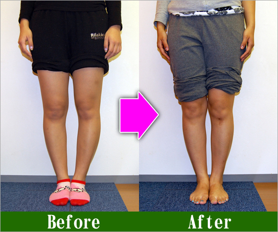 Ｏ脚矯正改善写真37