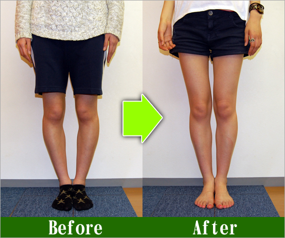 Ｏ脚矯正改善写真40