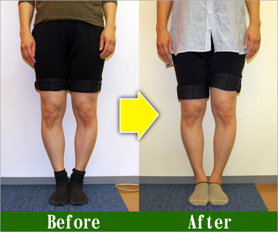 Ｏ脚矯正改善写真41