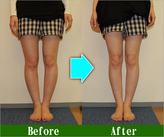Ｏ脚矯正改善写真45