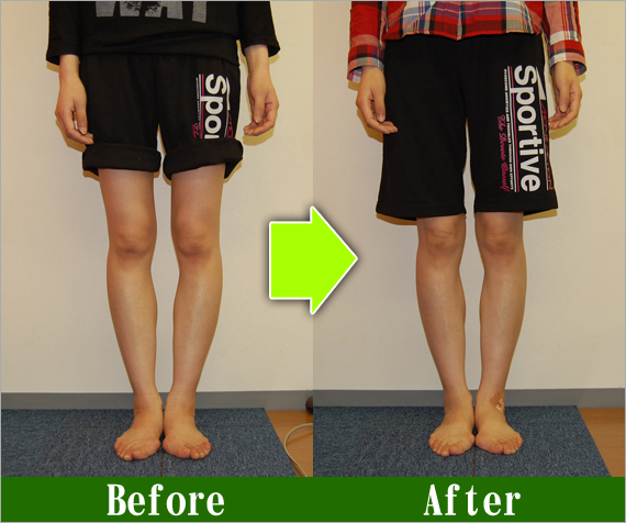 Ｏ脚矯正改善写真46