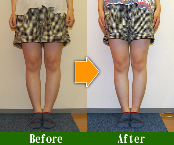 Ｏ脚矯正改善写真48