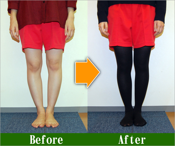 Ｏ脚矯正改善写真54
