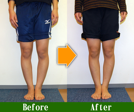Ｏ脚矯正改善写真60