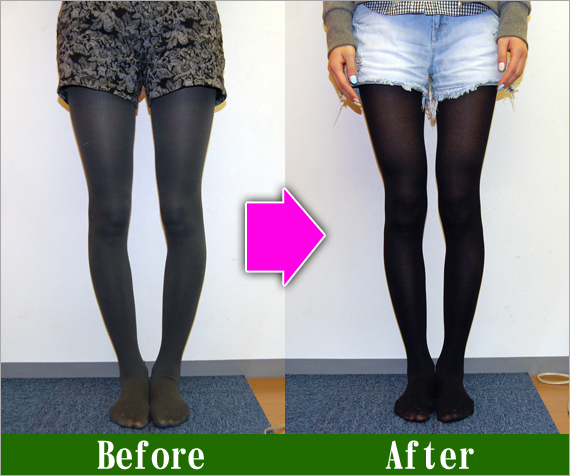 Ｏ脚矯正改善写真61