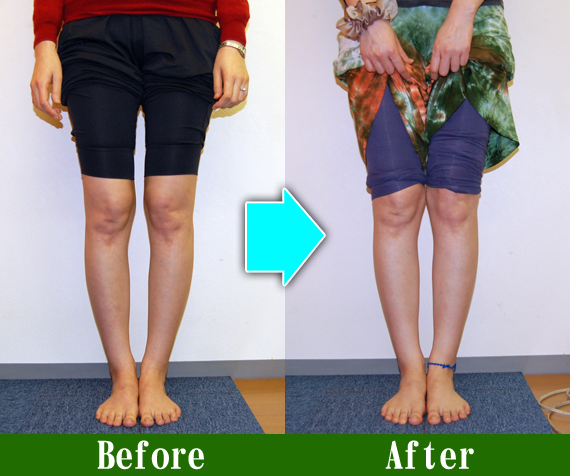 Ｏ脚矯正改善写真63