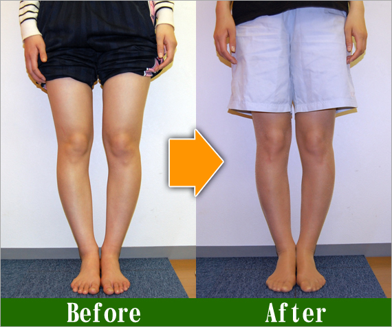 Ｏ脚矯正改善写真66