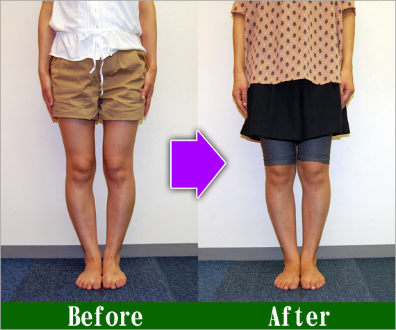 Ｏ脚矯正改善写真8