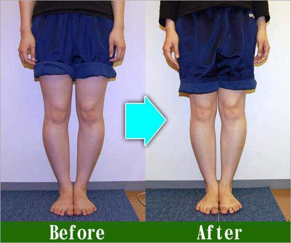 Ｏ脚矯正改善写真87