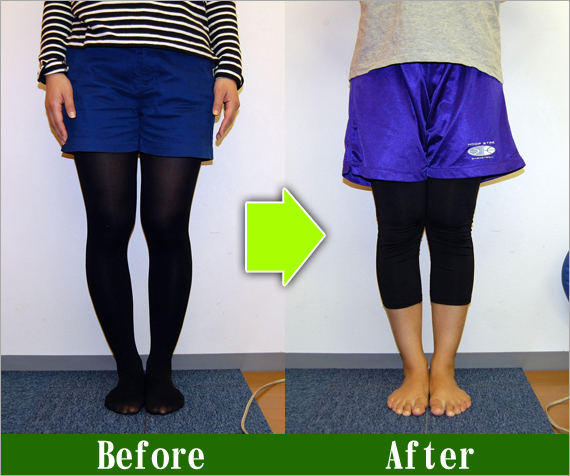 Ｏ脚矯正改善写真88