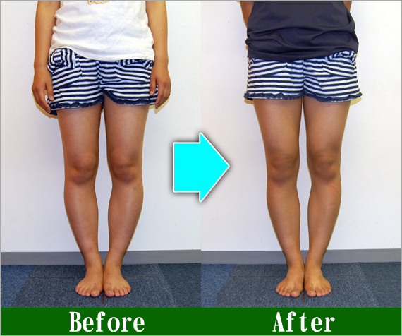 Ｏ脚矯正改善写真9