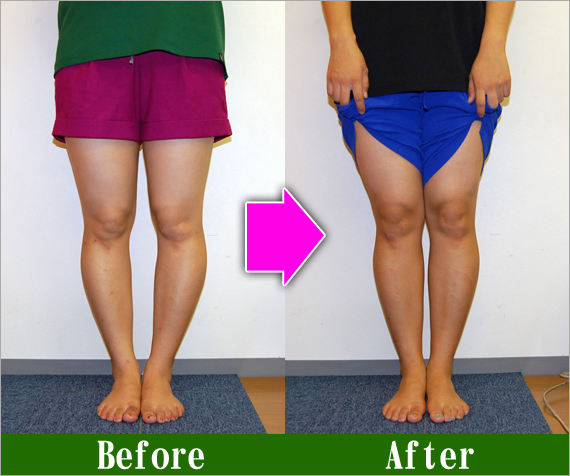 Ｏ脚矯正改善写真91