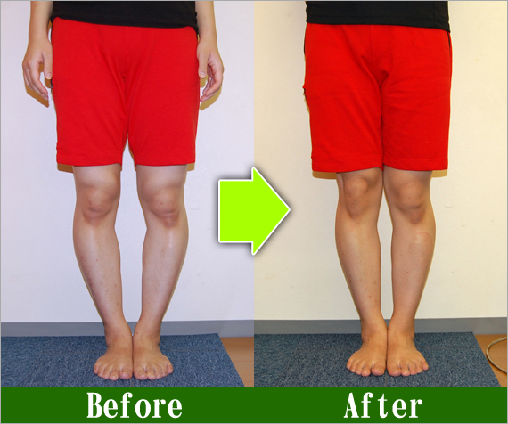 Ｏ脚矯正改善写真94