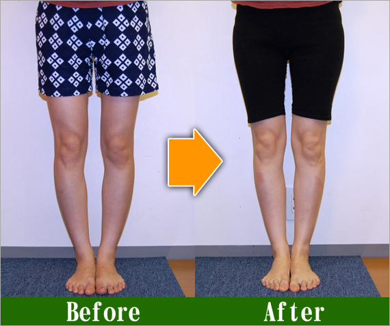 Ｏ脚矯正改善写真96