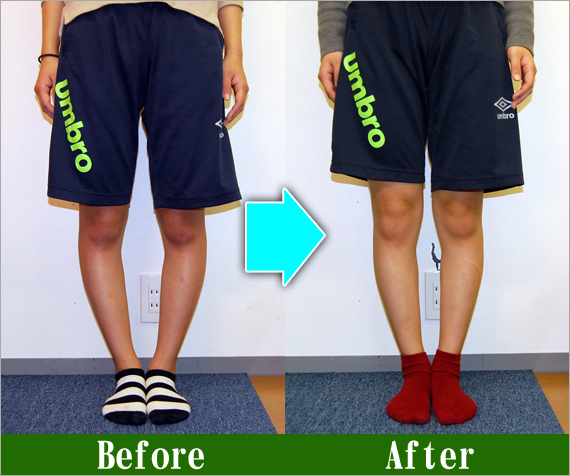 Ｏ脚矯正改善写真99