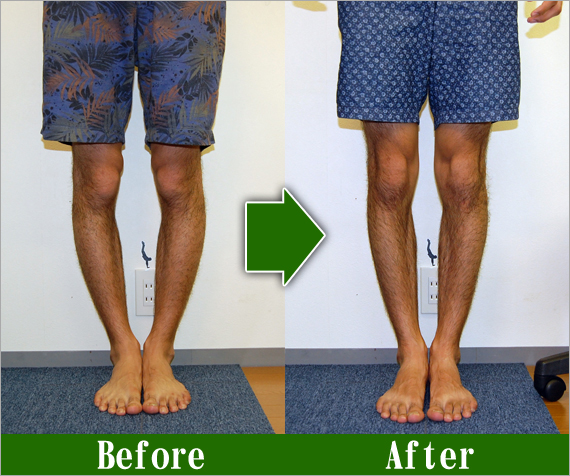 男性Ｏ脚改善2
